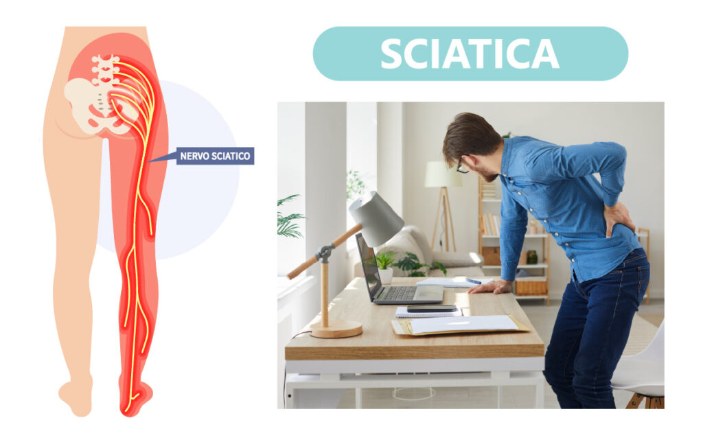 SCIATICA: COME AFFRONTARE IL DOLORE