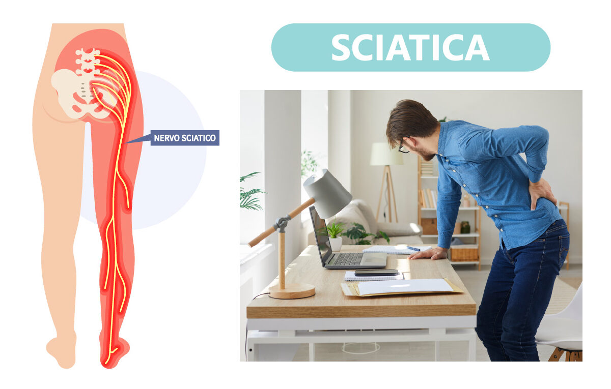 SCIATICA: COME AFFRONTARE IL DOLORE