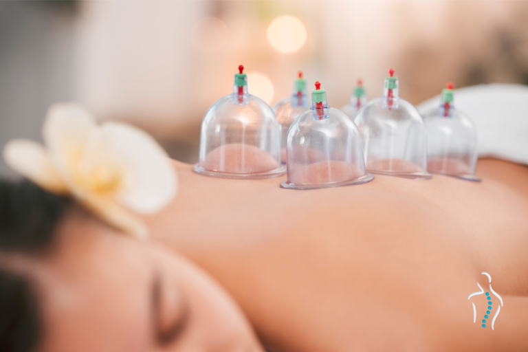 Cupping Therapy